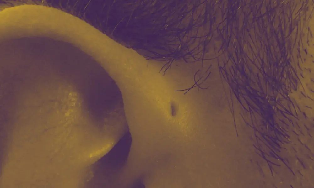 Preauricular sinus